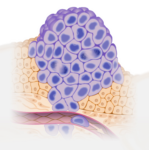Illustration of a cancer tumor growing on top of normal tissue and beginning to enter the bloodstream.